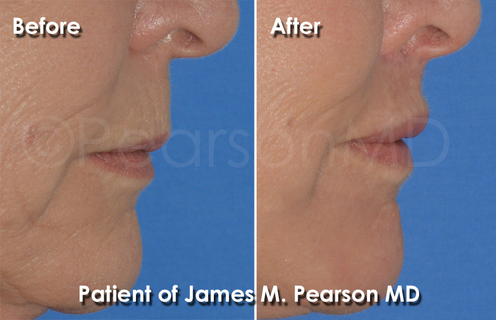 Pearson Plastic Surgery