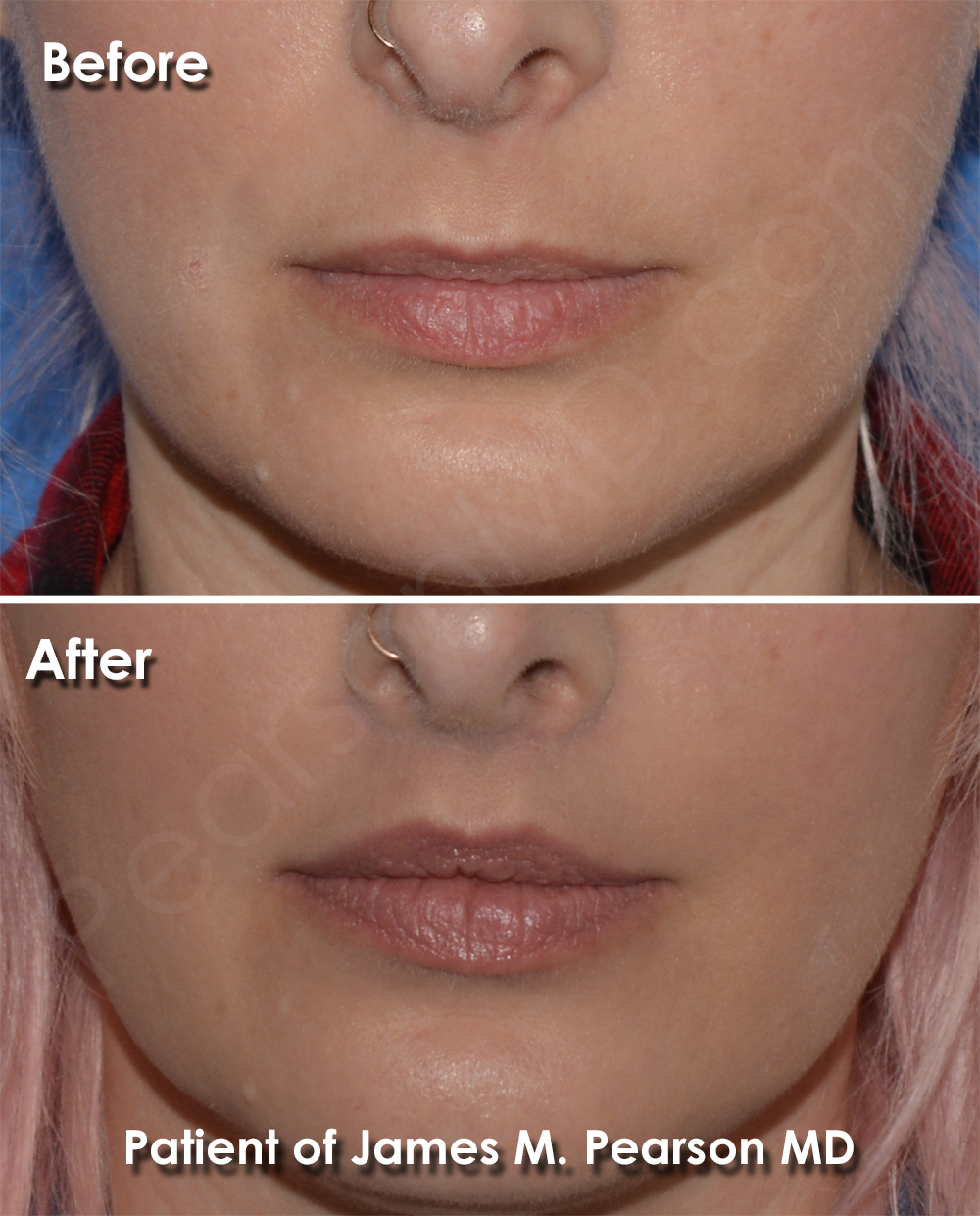 Photo Los Angeles Lip Lift by Dr. James Pearson Facial Plastic Surgery Pearson Lip Enhancement