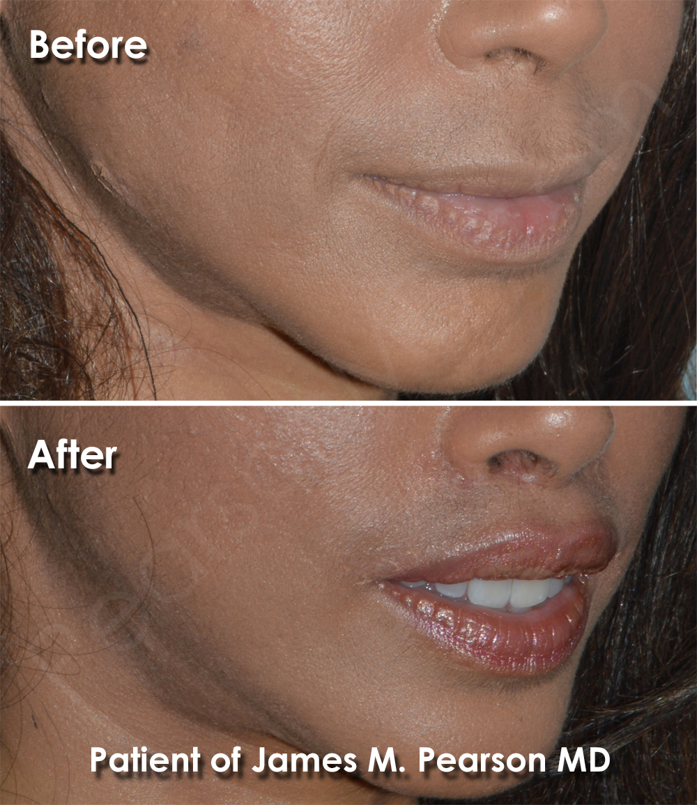 Photo Los Angeles Lip Lift by Dr. James Pearson Facial Plastic Surgery Beverly Hills Lip Lift