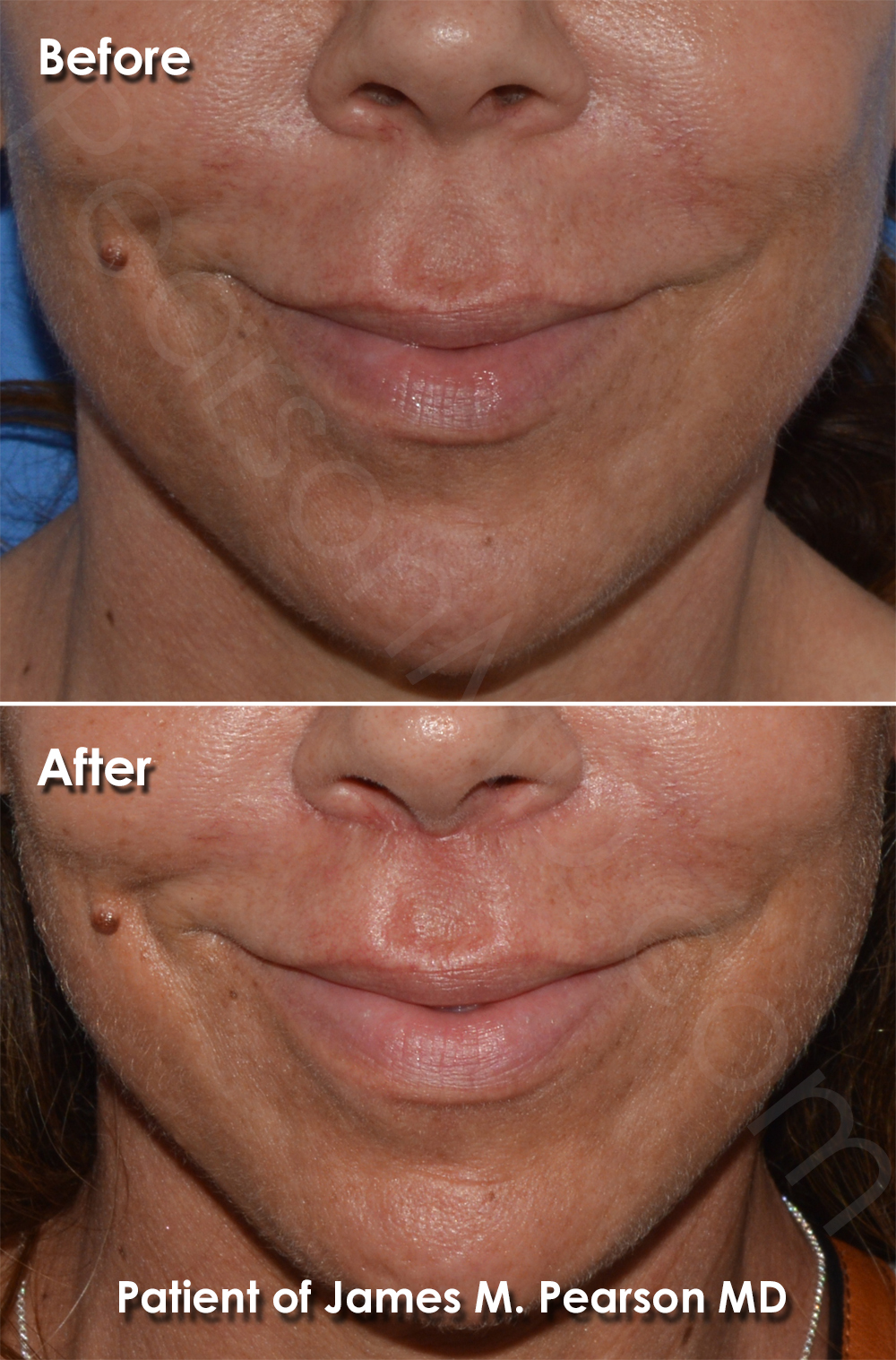 Photo Los Angeles Lip Lift by Dr. James Pearson Facial Plastic Surgery Pearson Lip Enhancement