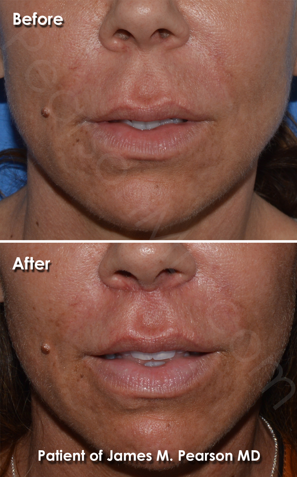 Photo Los Angeles Lip Lift by Dr. James Pearson Facial Plastic Surgery Pearson Lip Surgery
