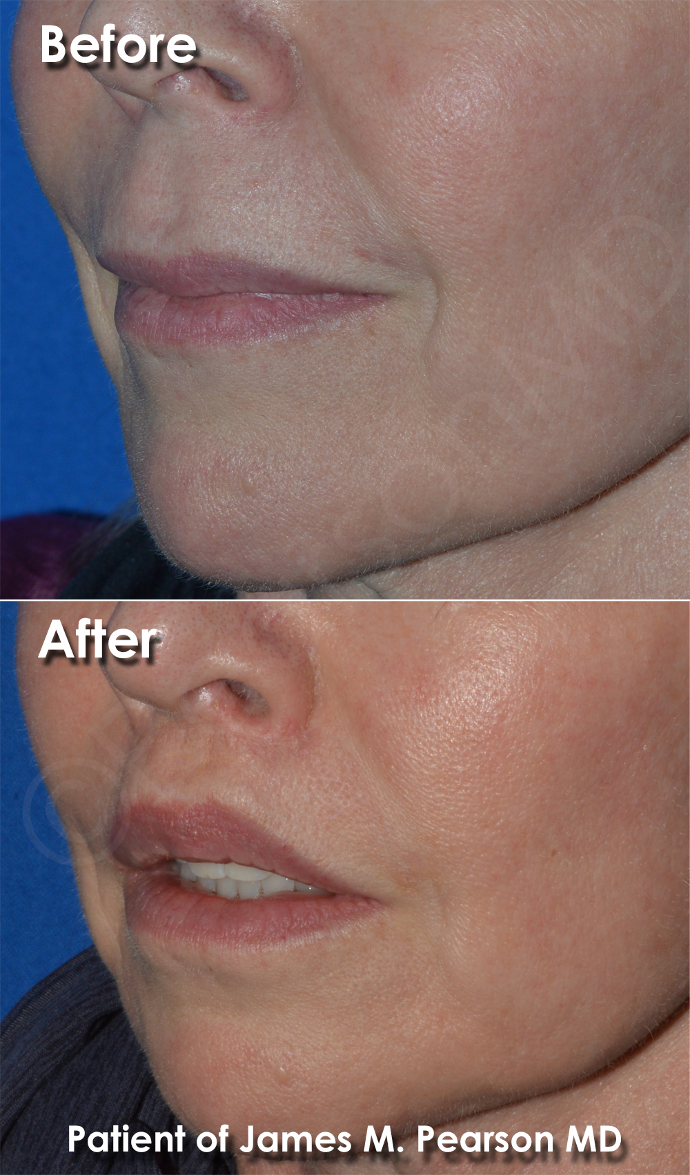 Lip Lift Specialist Beverly Hills