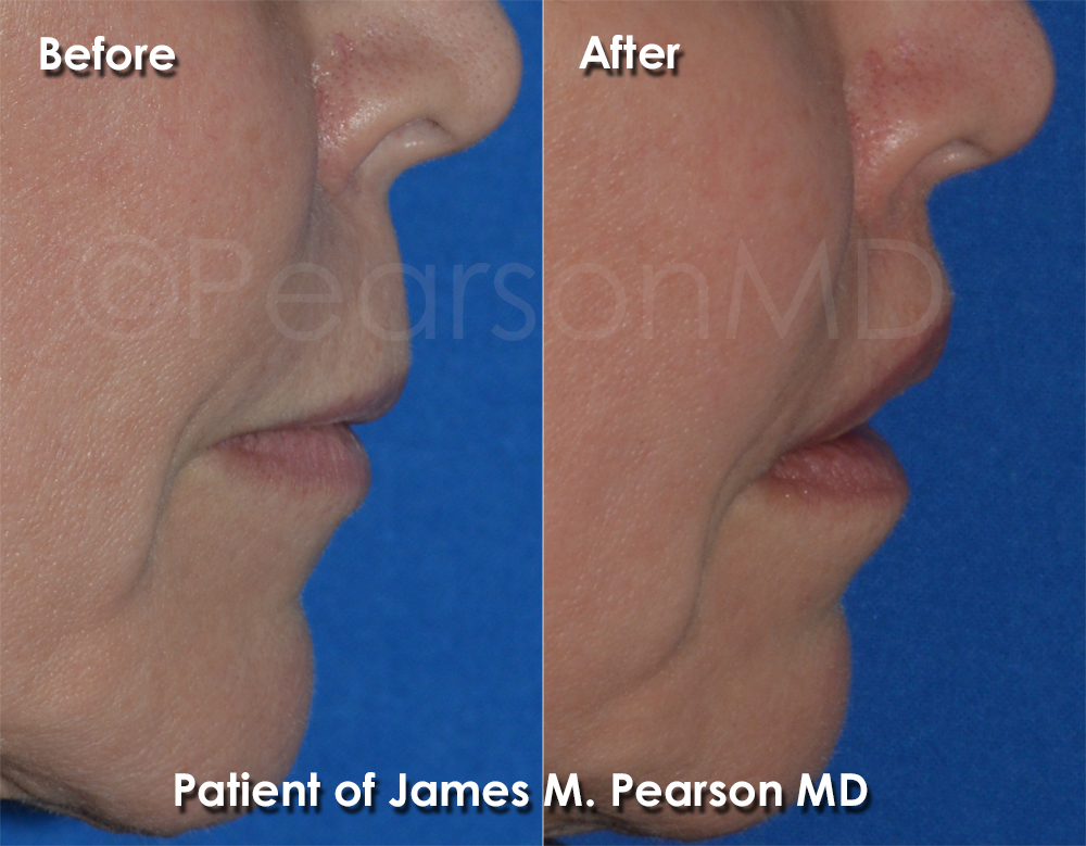 Dr. Pearson Plastic Surgeon