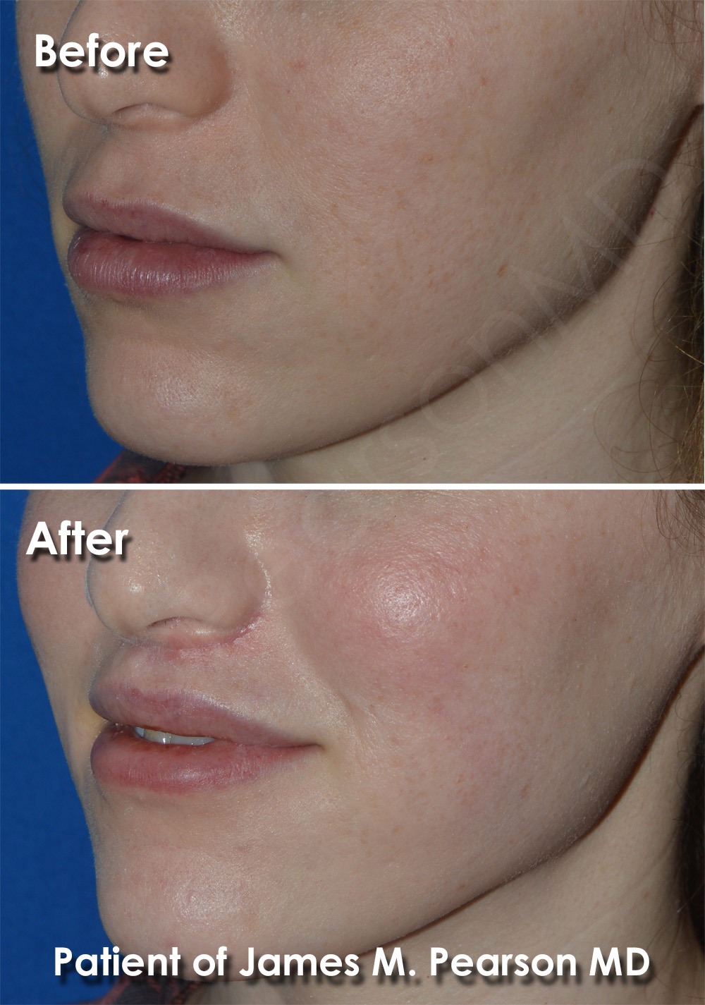 Dr. Pearson Lip Lift