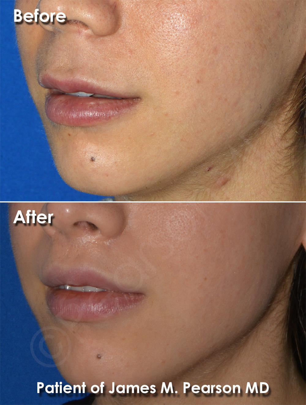 Pearson Lip Lift