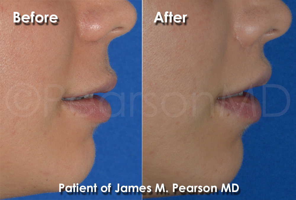 Lip Lift Side Profile View