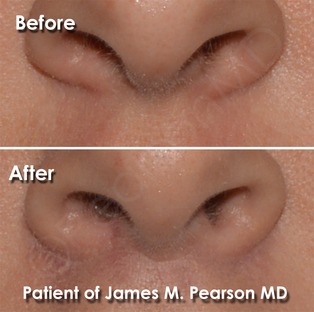 Bullhorn Lip Lift Scar