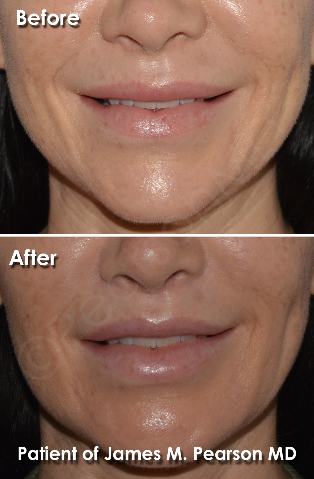 Dr. Pearson Plastic Surgeon