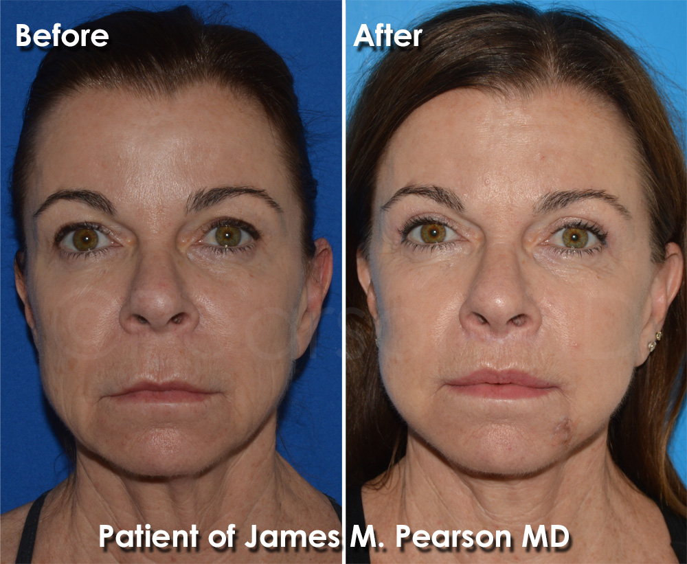 Pearson Plastic Surgery