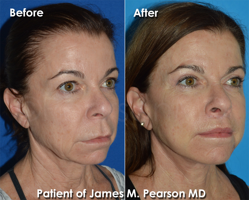 Dr. Pearson Plastic Surgery