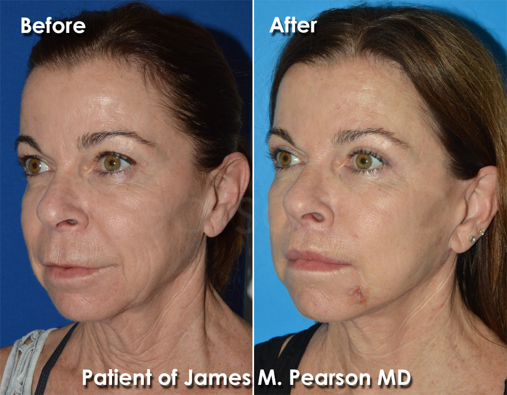 Dr. Pearson Plastic Surgeon