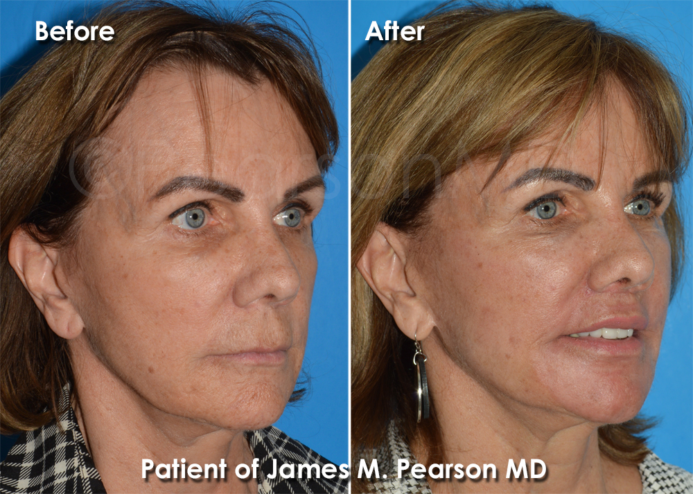 Pearson Plastic Surgery