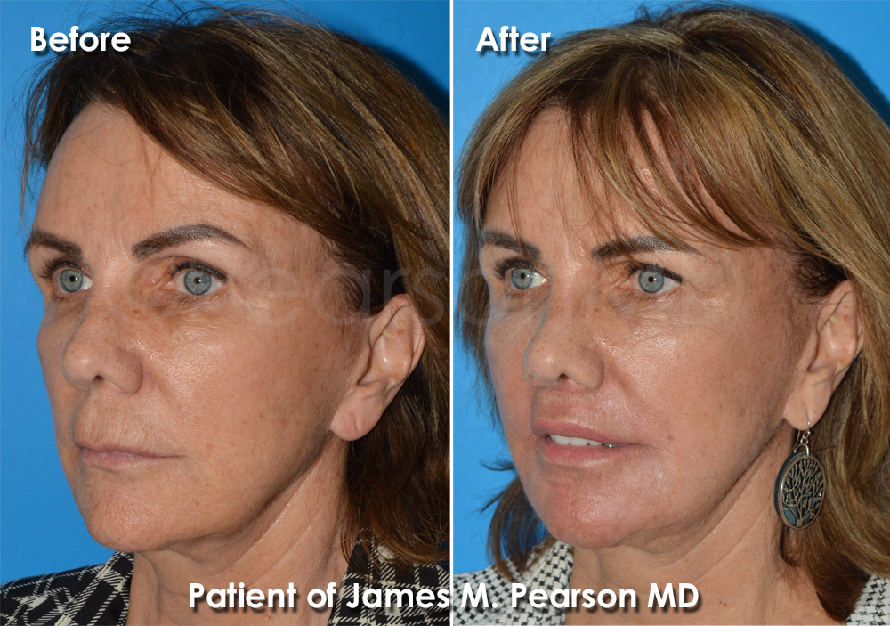 Pearson Plastic Surgery
