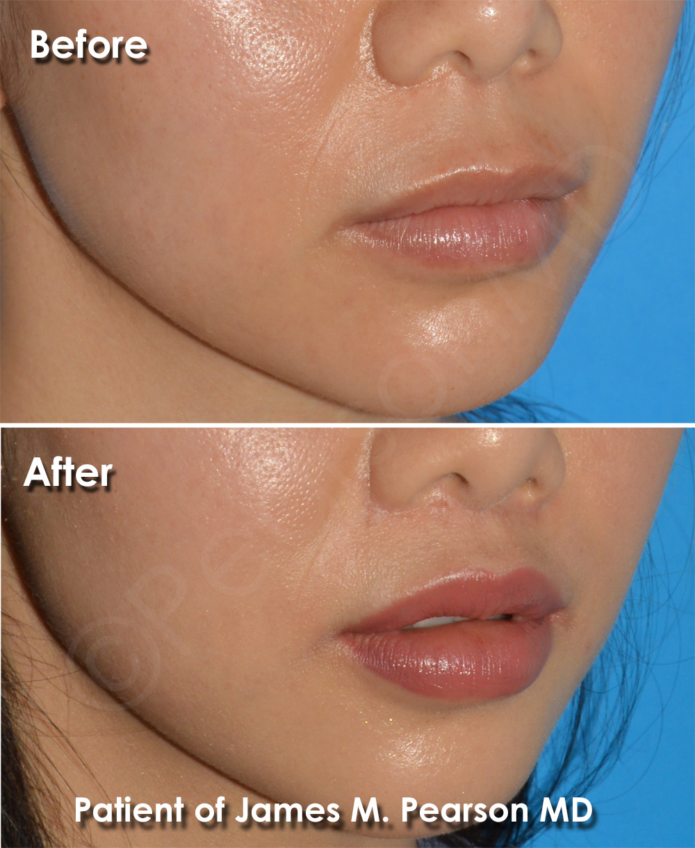 Dr. Pearson Plastic Surgeon