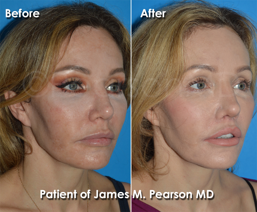 Dr. Pearson Plastic Surgeon