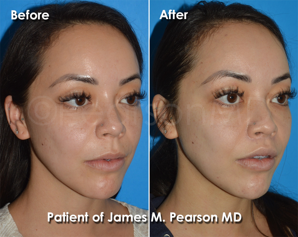 Dr. Pearson Plastic Surgeon