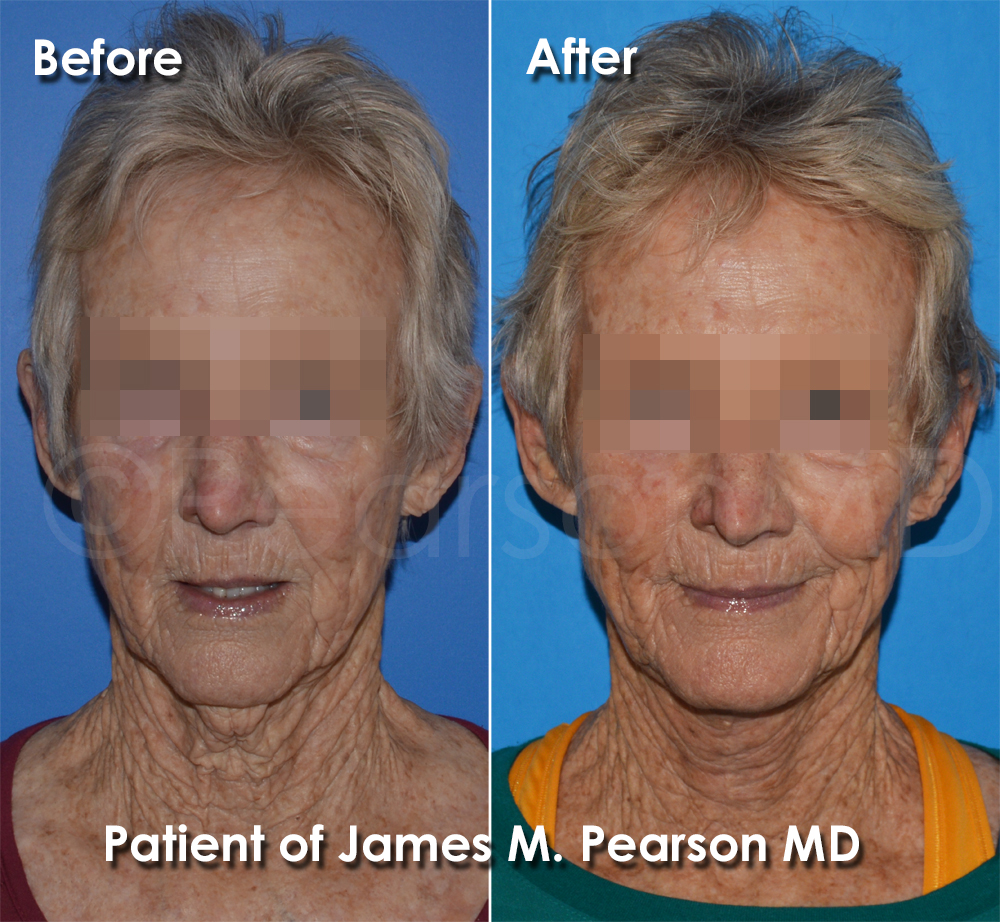 Pearson Plastic Surgery