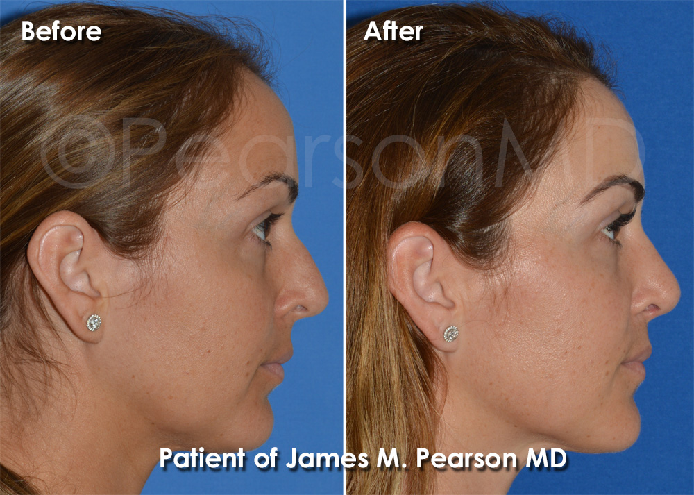 Pearson Rhinoplasty