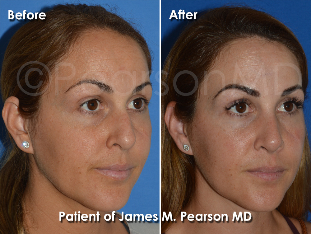 Dr. Pearson Rhinoplasty