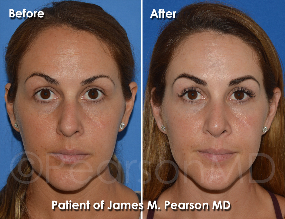 Pearson Rhinoplasty
