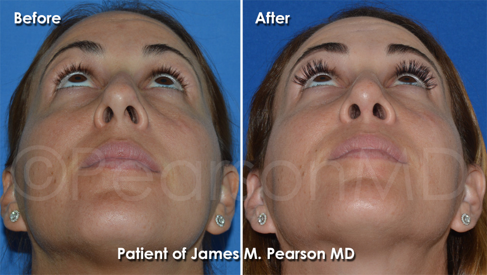 Dr. Pearson Rhinoplasty