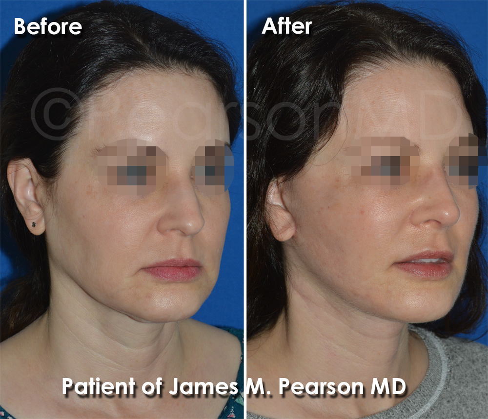 Manhattan Beach Rhinoplasty