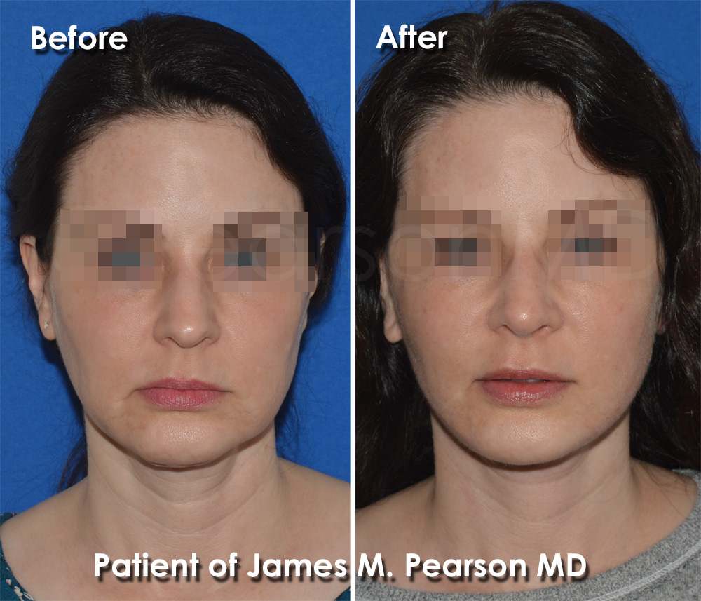 Torrance Rhinoplasty