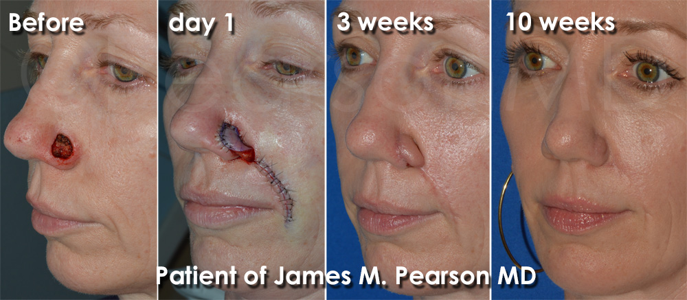 Dr. Pearson Reconstructive Surgery